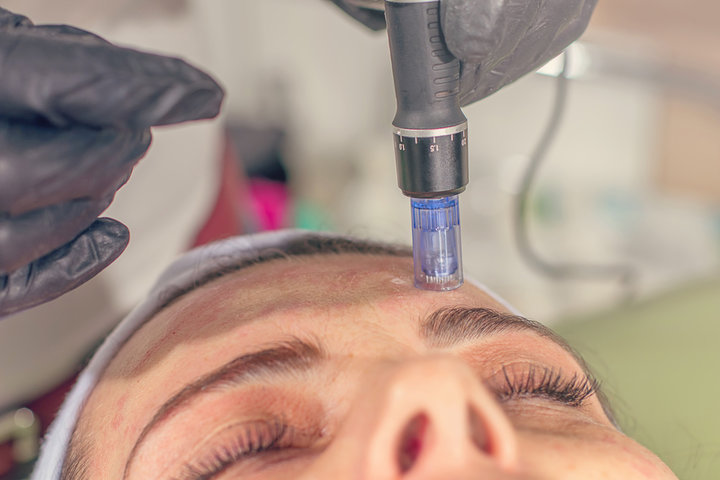 Microneedling with PRF image